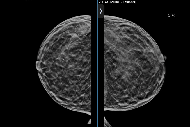 Breast Imaging with Faxitron